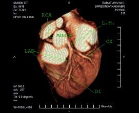 Виртуальная коронарография
